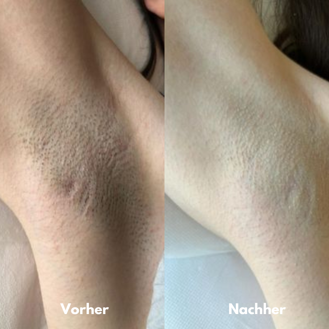 IPL Pro - Dauerhafte Haarentfernung