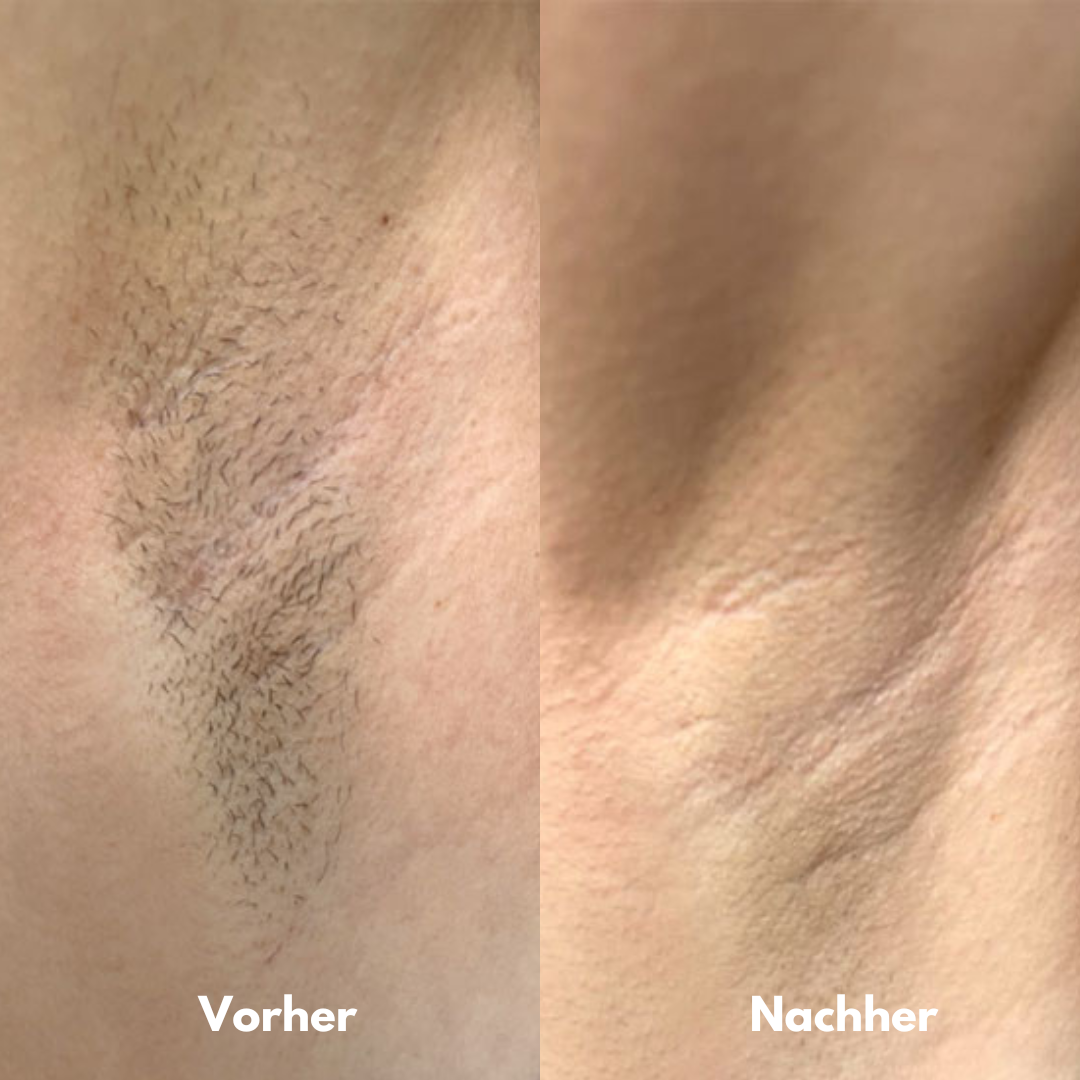 IPL Pro - Dauerhafte Haarentfernung