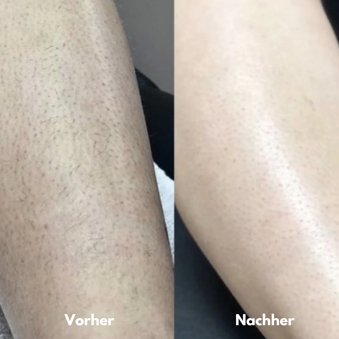 IPL Pro - Dauerhafte Haarentfernung