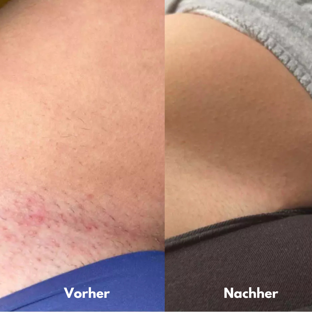 IPL Pro - Dauerhafte Haarentfernung